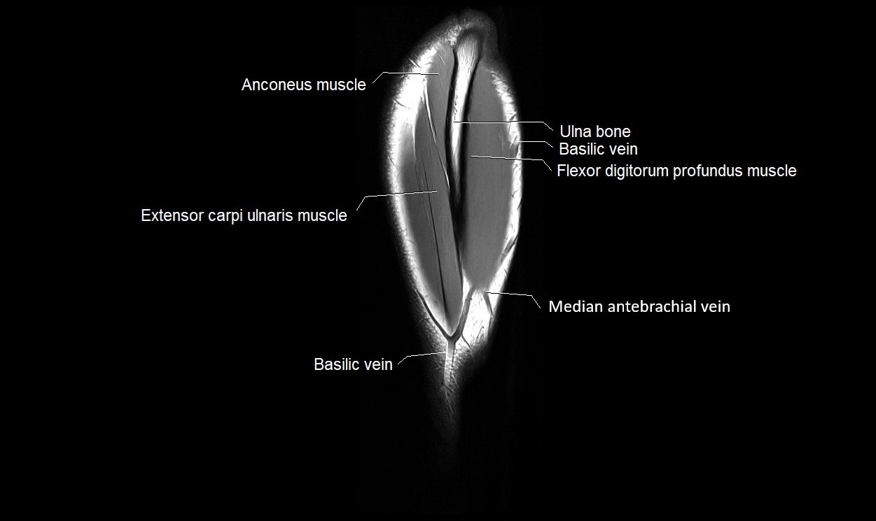 MRI 3T forearm coronal cross sectional anatomy image 25.webp